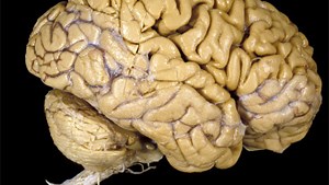 This is your brain on deep brain stimulation