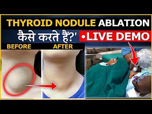 How Thyroid Nodule Lump Is Being Removed Without Surgery | Dr. Gaurav Gangwani (IR)