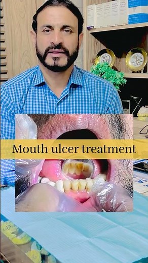 Mouth Calculus Removal | Clean Teeth in Minutes 🦷✨