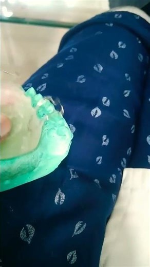 #removableappliance#midlinediastema#fingerspring