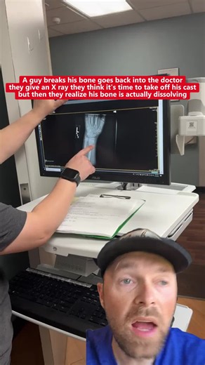 Why a Broken Bone Can Dissolve After Casting: X‑ray Surprise Explained