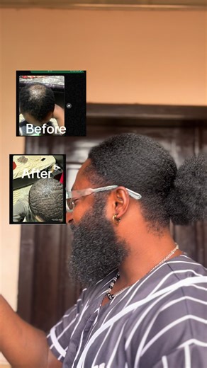 Transforming Baldness: Before and After Results