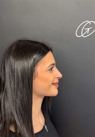 Rinofiller: Trasformazione del Naso in Bellezza