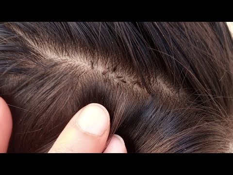 ASMR lices nites picking removed school girl!..