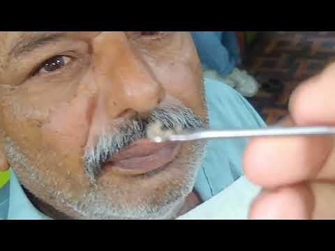 blackheads removal with sac dep spa face treatments | skin cyst face treatments 2023 | before after