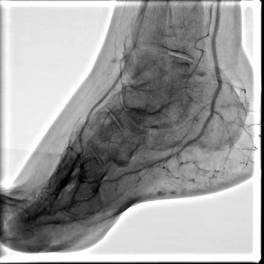 Balloon angioplasty of the femoral artery