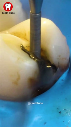 Removal of an amalgam filling.