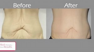 ReFit by Viora for Non-Invasive Skin Tightening After Weight Loss — See These 4 Transformations