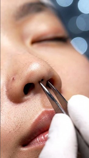 🤯 Blackhead EXPLOSION! 💥 The MOST Satisfying Removal EVER! 😱