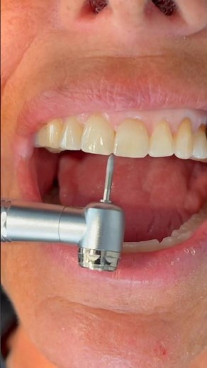 Reshaping Worn / Chipped Teeth After Braces Or Invisalign