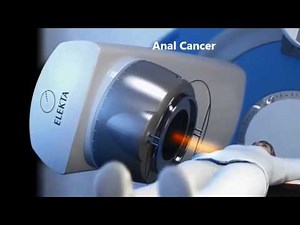 External Beam Radiotherapy for Colorectal and Anal Cancer - English