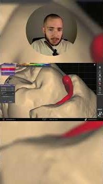 Dica de espessura Minima e Bordo para inlay no #exocad ... #cadcam #dental #dentalcad #dentista