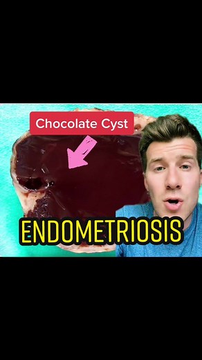 Understanding Chocolate Cysts and Endometriosis: A Women's Health Guide