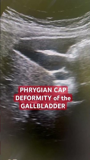 Phrygian Cap Deformity of Gallbladder #gallbladder #gallbladderultrasound #phrygiancapdeformity