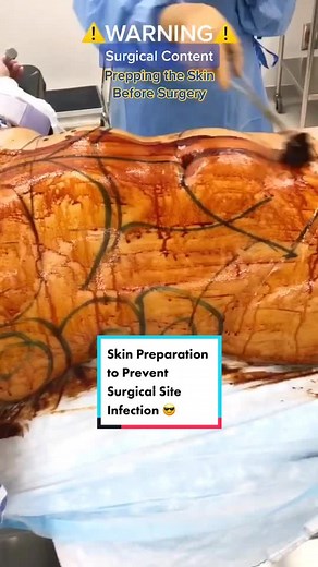 Do you know what we use to prep the #Skin before #Surgery? 🤔 #PlasticSurgery #OperatingRoom #Surgeon #LearnOnTikTok #Medical #TummyTuck #FYP