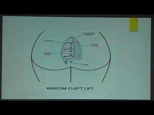 6.1 Pilonidal Sinus - Dr Lalit Aggarwal