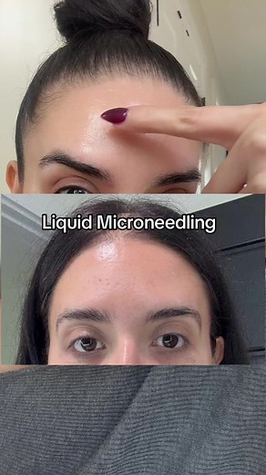 Microneedling: Transform Your Skin with Medicube
