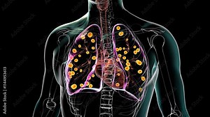 Lung histoplasmosis, 3D animation showing fungal infection caused by Histoplasma capsulatum, highlighting lung tissue damage and granulomas.