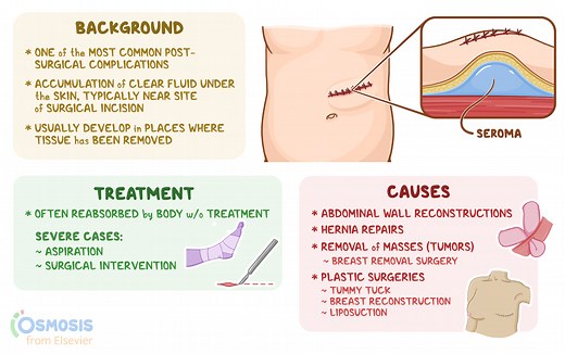 Seroma: What Is It, Causes, Treatment, and More | Osmosis