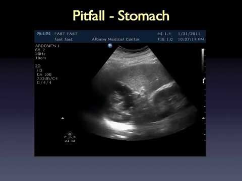 FAST Scan Ultrasound Lecture