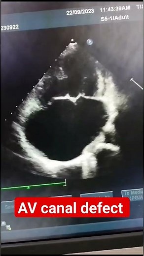Atrioventricular (AV) canal defect in ECHO