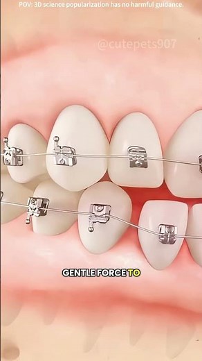 How braces works?(3D animation) #drone #theflash #space #automobile #scifi #doctor #3danimation