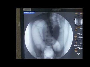 Pushing the limits- Pneumatic reduction of very long segment intussusception.