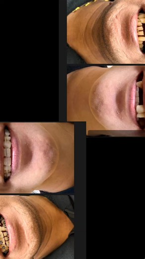 Understanding Dentures with Bracket: A Comprehensive Guide