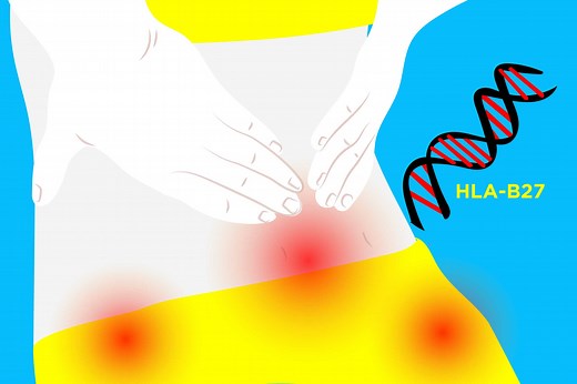 The HLA-B27 Gene and Ankylosing Spondylitis: What’s the Connection?