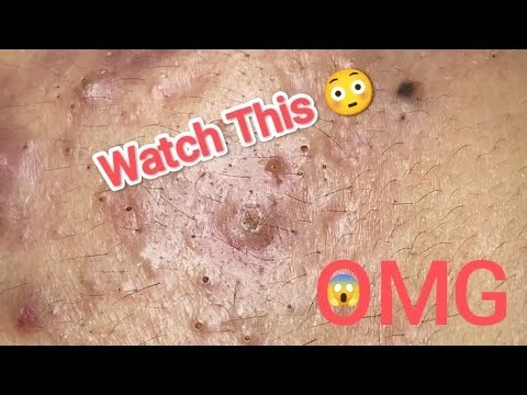 "Satisfying Blackheads Removal 😱 | Deep Facial Cleaning ASMR"