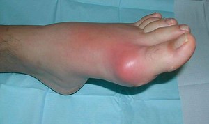Gouty tophi causes, symptoms, diagnosis & treatment