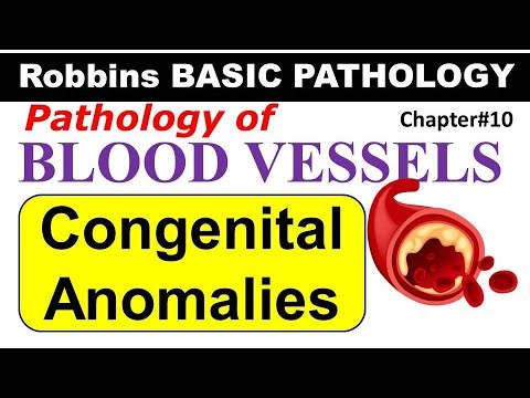 Ch12 | Congenital Anomalies of Blood Vessels | Blood Vessel Pathology | Robbins Lectures