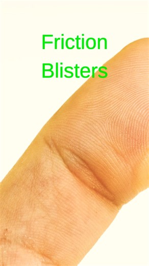 Friction Blisters: Heal Faster with These Simple Steps! 🌿