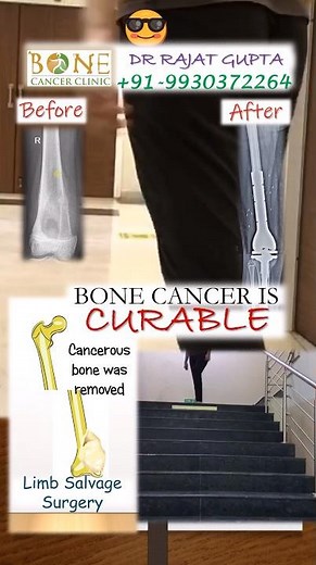 Ewing Sarcoma #bonecancer #knee patient walk after surgery-Dr Rajat Gupta ‪@bonecancerclinic‬
