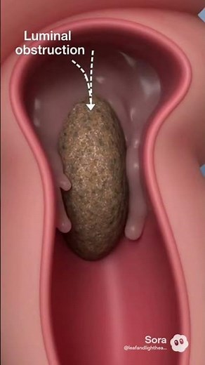 Acute Appendicitis #shortvideo