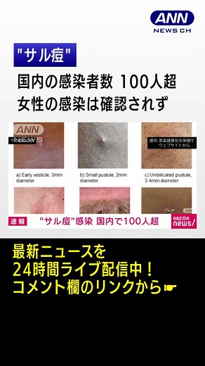 「サル痘」国内の感染者数が100人超える 厚労省 #shorts