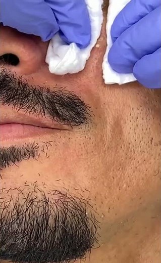 Removing large blackheads and pimples from face new 2021 #230