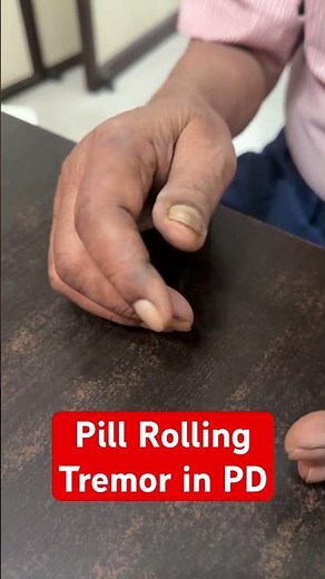 Pill Rolling Tremor in Parkinson’s Disease #parkinsondisease #restingtremor #drsorabhgupta