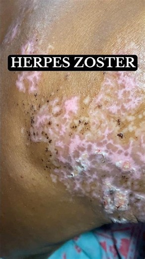 Herpes symptoms | Varicella #shorts #skincare #herpeszoster
