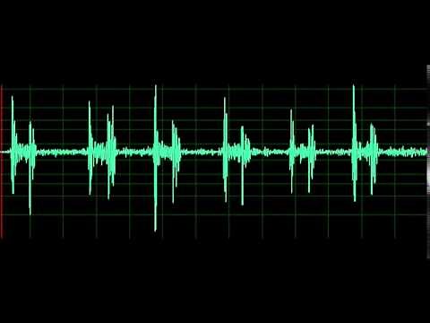 Pulmonary Associated Heart Sounds- Tricuspid Regurgitation
