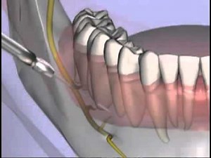 Malamed's Local Anesthesia 11 Supplemental Injection Techniques