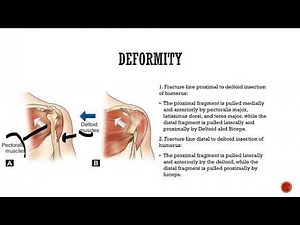 Humerus shaft fractures