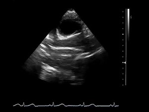SSN (Suprasternal notch)