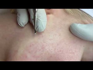 Finding and extracting hidden sebum deposits in the skin.