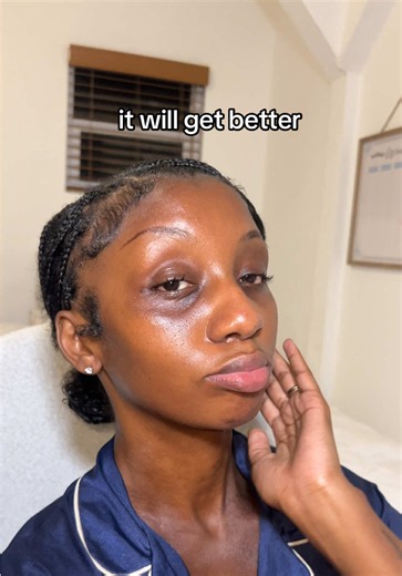 #eczemaawareness #eczema #eczemaflareup #tsw #eczematok | bio oil