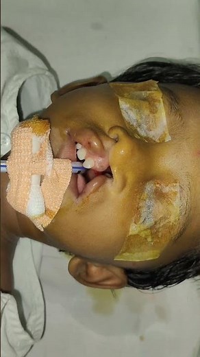 Cleft Lip Repair Surgery: Before and After Result Dr Parit Ladani