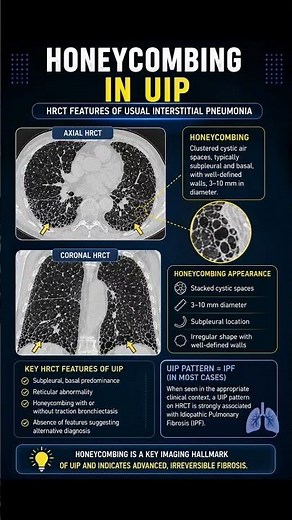 Honeycombing in UIP- HRCT chest