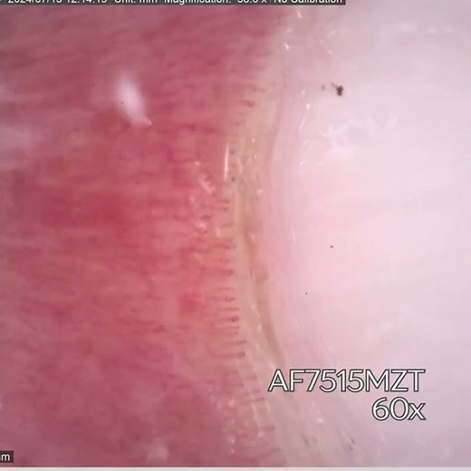Inspecting Nailfold Capillaries with multiple Dino-Lite Digital Microscopes
