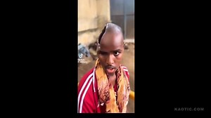 Somali Man Is Somehow Able To Function With Half His Brain And Skull Missing
