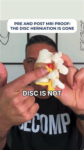 Herniated disc relief: non-surgical decompression that changes the disc (MRI proof) #spine #MRI